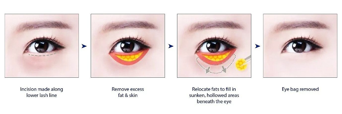 Fat Repositioning Eye Bag Surgery Singapore