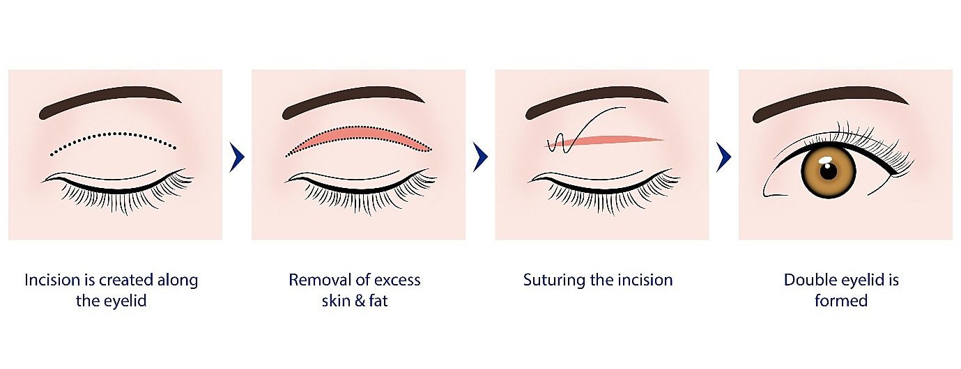Incisional Double Eyelid Surgery