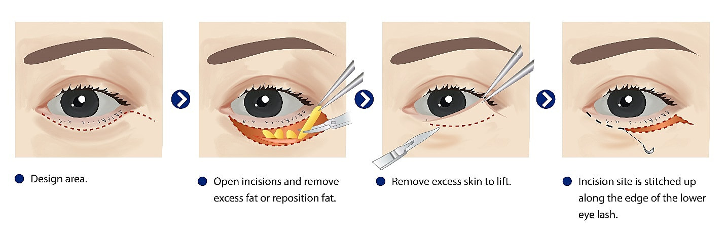 Incisional Eye Bag Removal