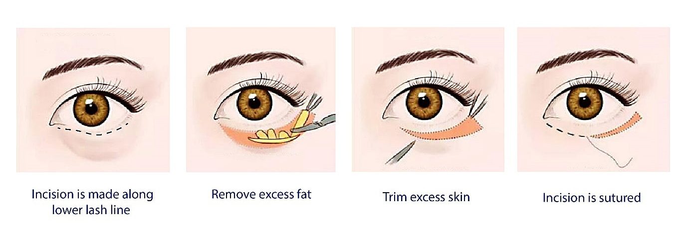 Incisional Eye Bag Surgery Singapore