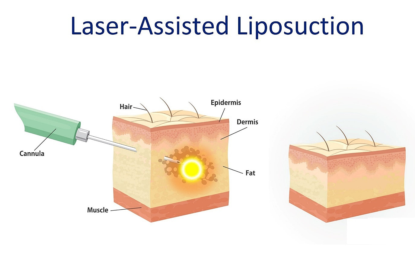 Laser-Assisted Liposuction
