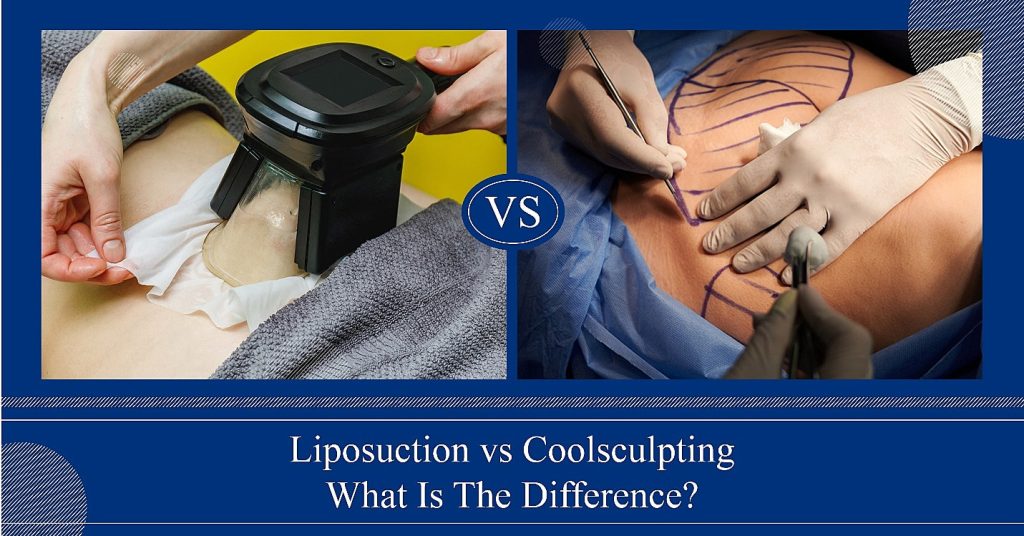 Liposuction vs Coolsculpting - What Is The Difference