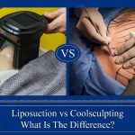 Liposuction vs Coolsculpting - What Is The Difference