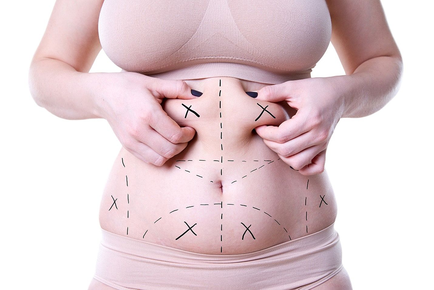 Misconception About Weight Loss And Liposuction