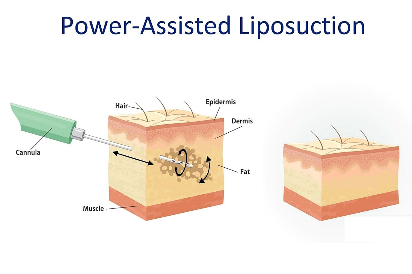 Power-Assisted Liposuction