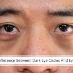 The Difference Between Dark Eye Circles And Eye Bags