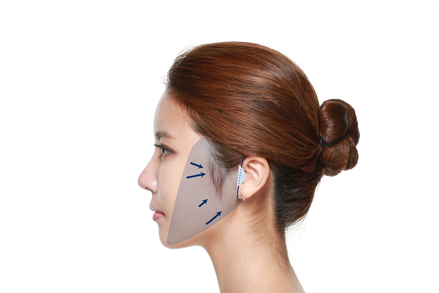 Traditional Facelift