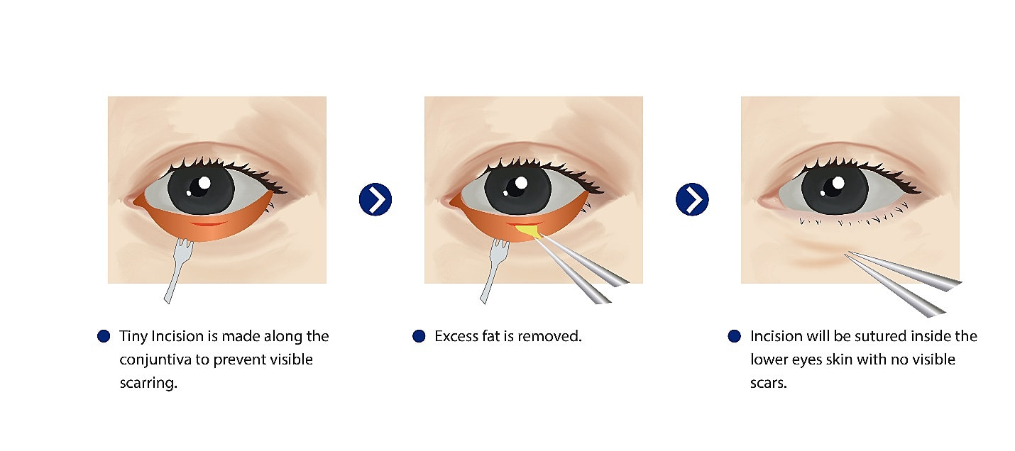 Transconjunctival Eye Bag Removal