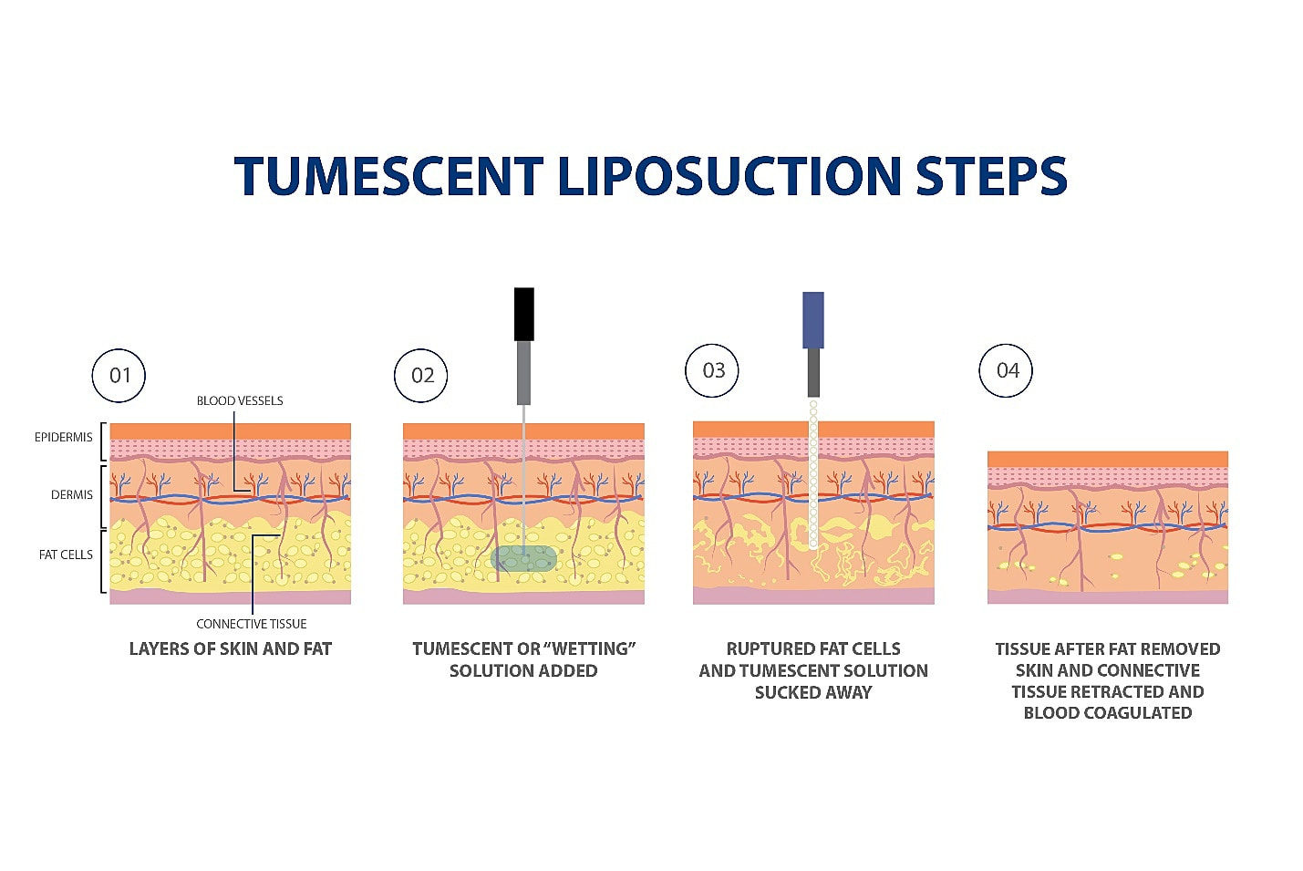 Tumescent Liposuction