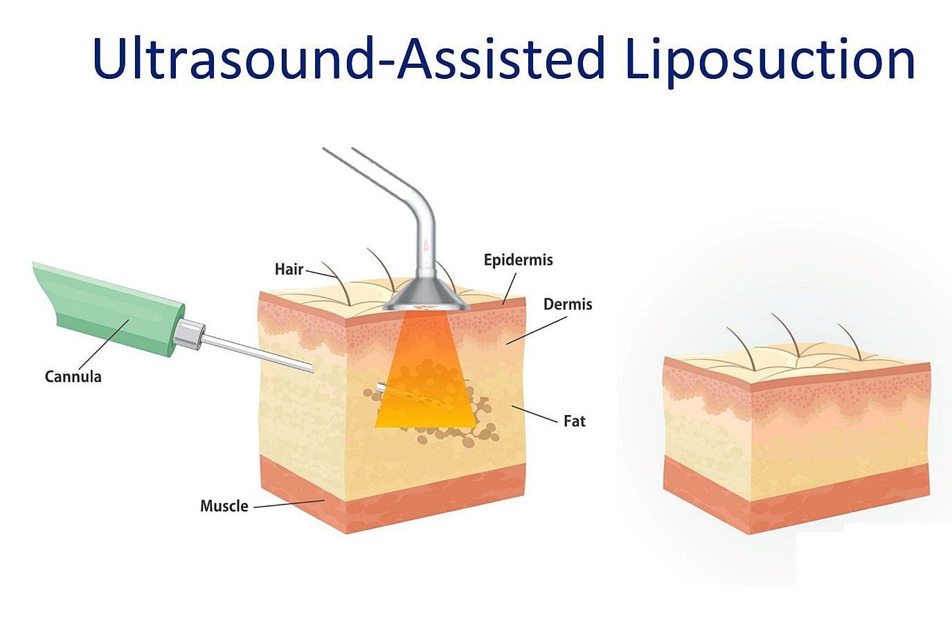 Elimination of back roll following ultrasound-assisted liposuction