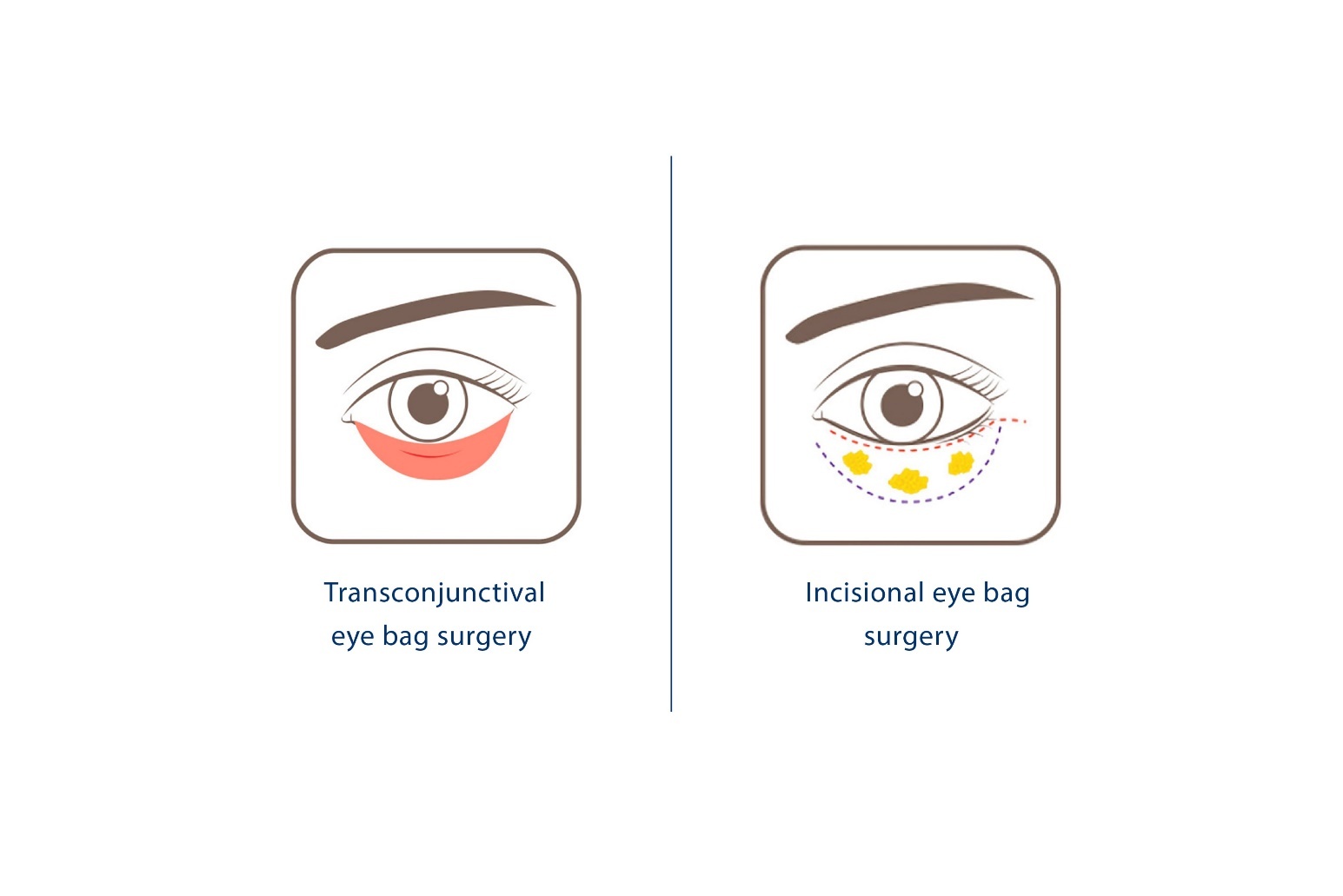 Eye Bag Surgery in Singapore