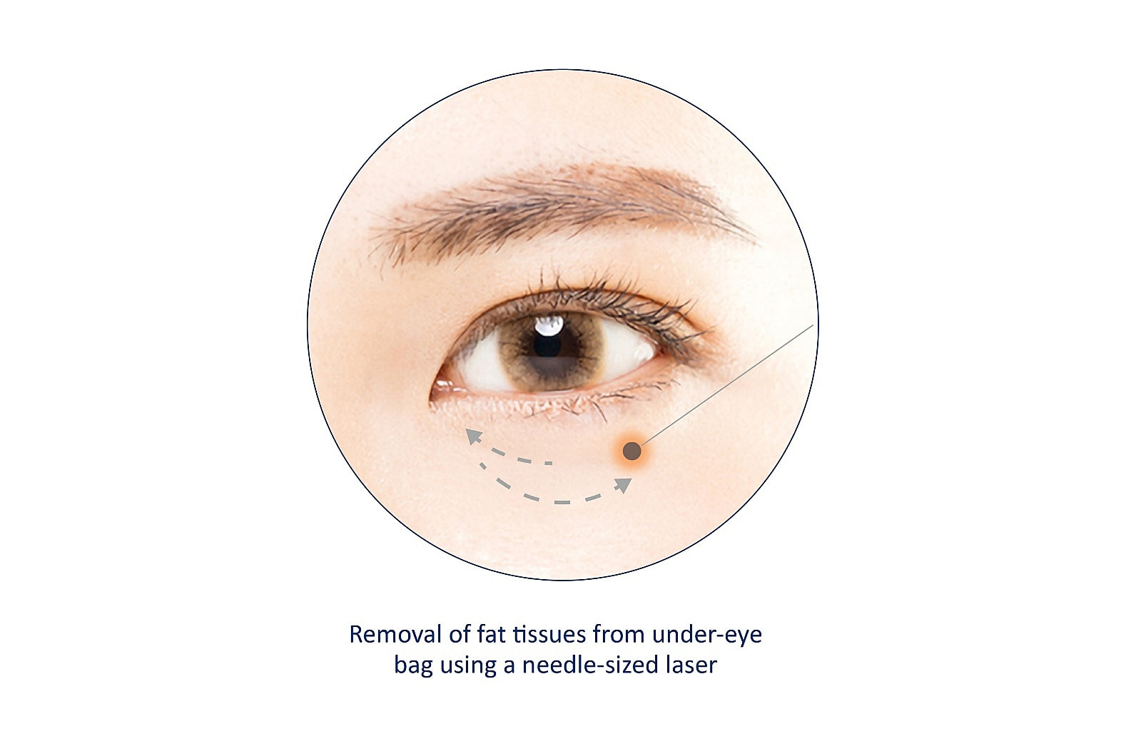 Non-Surgical Eye Bag Removal in Singapore