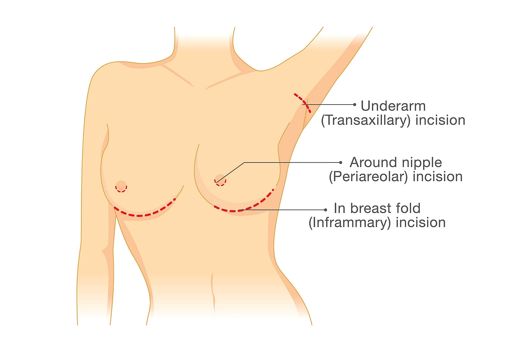 Round Breast Implant Procedure