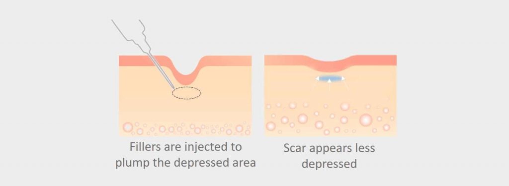 Pico Laser for Acne Scars in Singapore | Dream Plastic Surgery