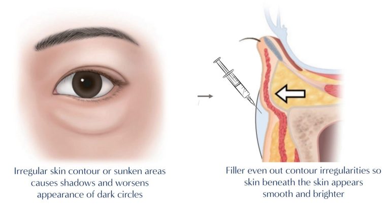 Dermal-Filler-Treatment-Eye-Bag-scaled