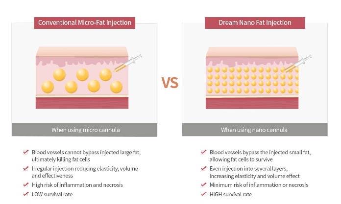 Micro Fat vs Nano Fat – innovative cosmetic treatments.