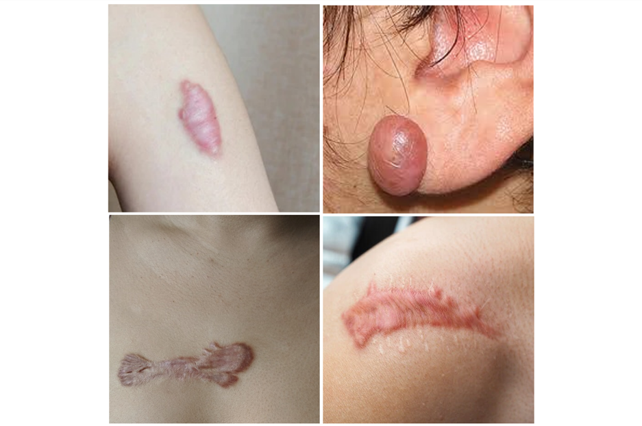 keloid acne scars