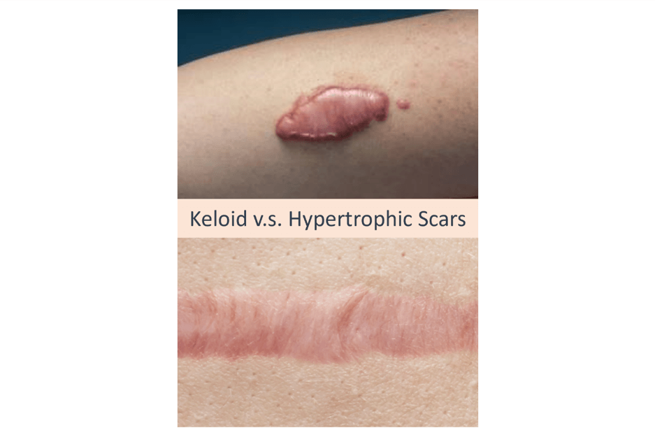 keloid vs hypertrophic scars