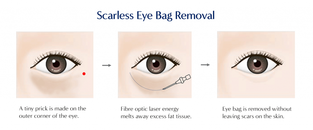 Scarless-Eye-Bag-Removal