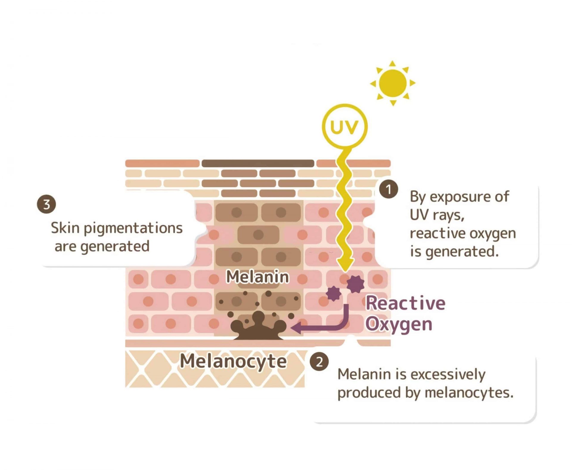 Laser Treatment For Pigmentation In Singapore Dream Plastic Surgery
