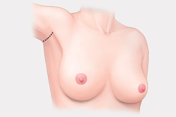 armpit-incision.jpg