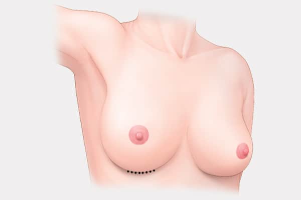 breast-fold-incision.jpg