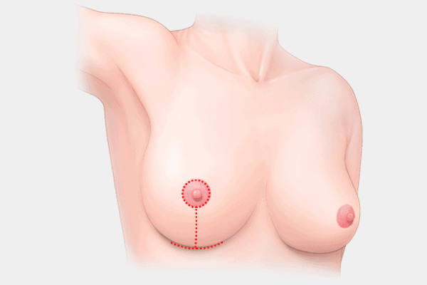 breast-lift-anchor-incision.png