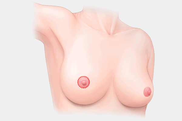 breast-lift-areola-incision.png