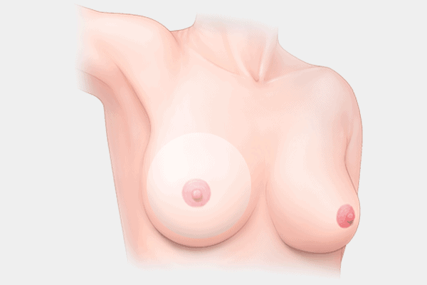 breast-lift-method.png
