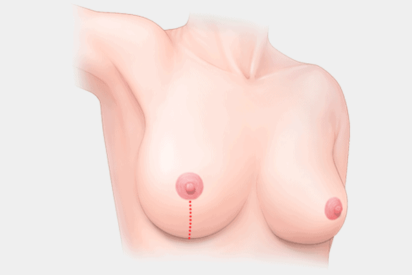 breast-lift-vertical-incision.png