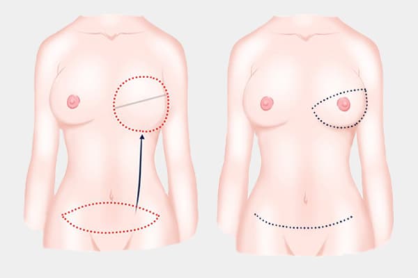 Types of breast reconstruction
