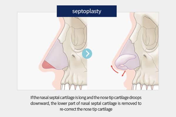 setoplasty-600x400-1.jpg