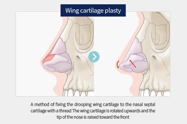 wing-cartilage-600x400-1.jpg