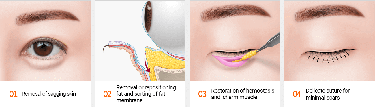Incisional Eye Bag Removal Surgery Method