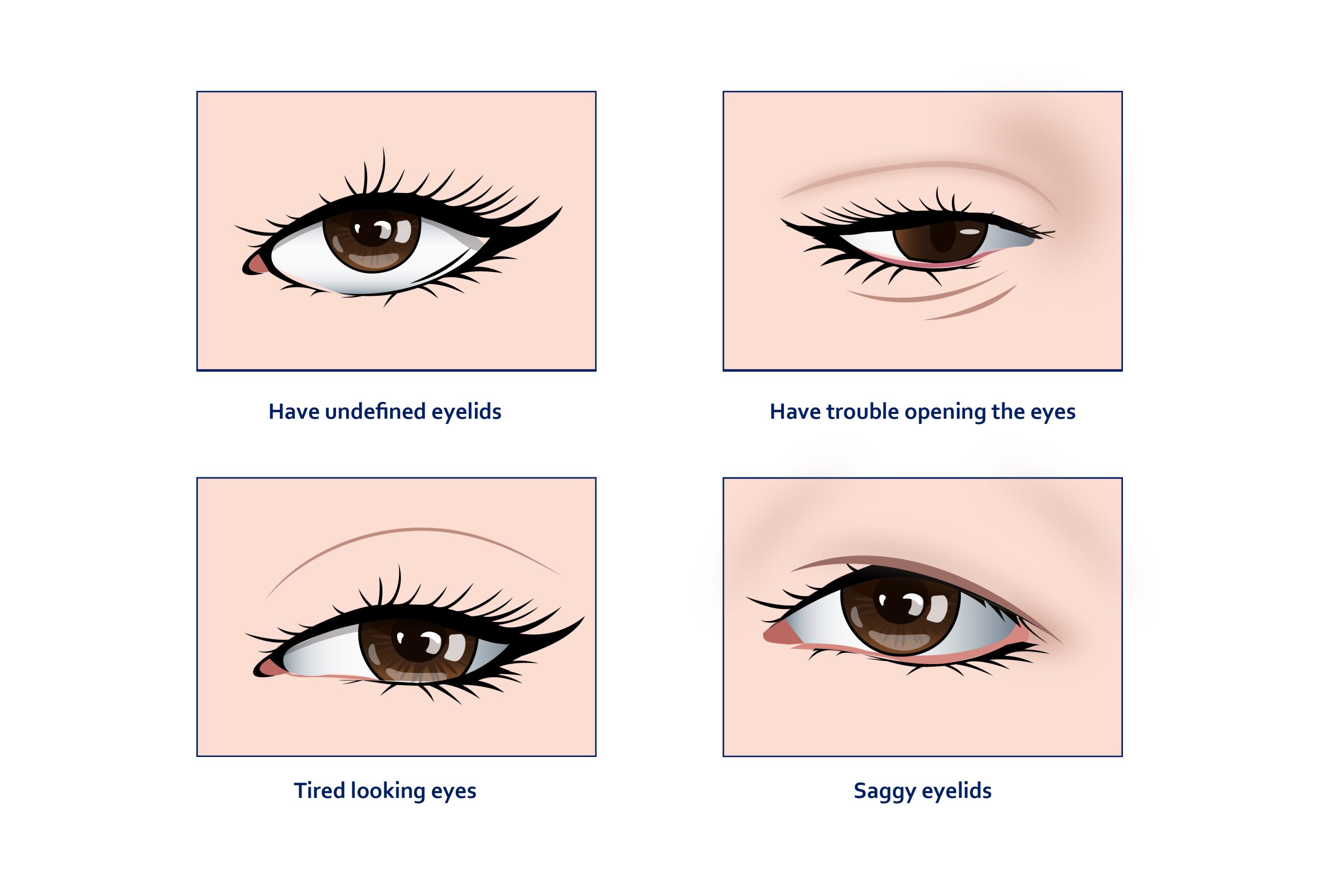 Necessities For Ptosis Correction Surgery