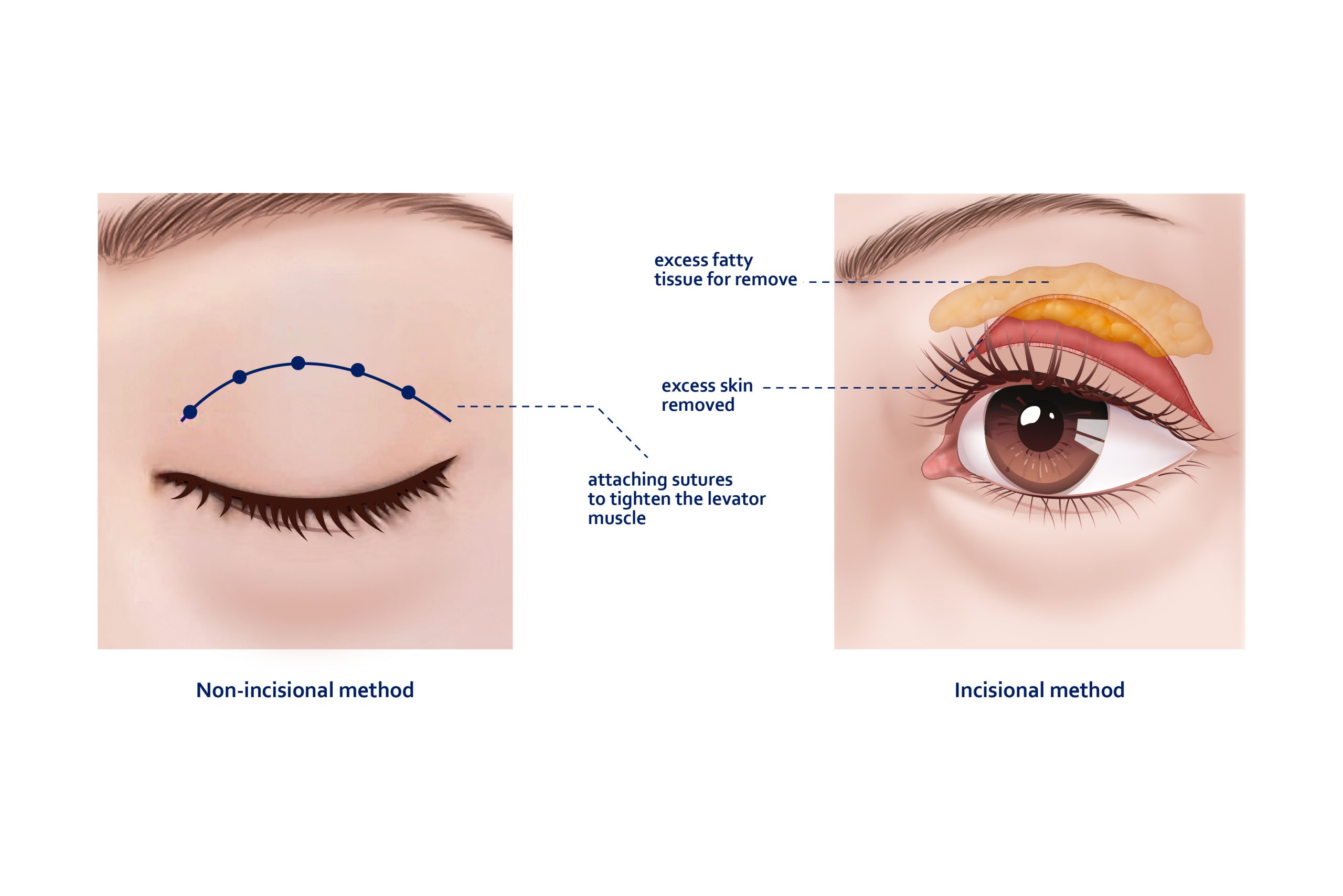 Techniques Of Ptosis Correction in Singapore