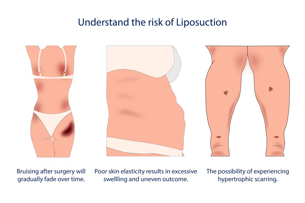 The risks of liposuction.