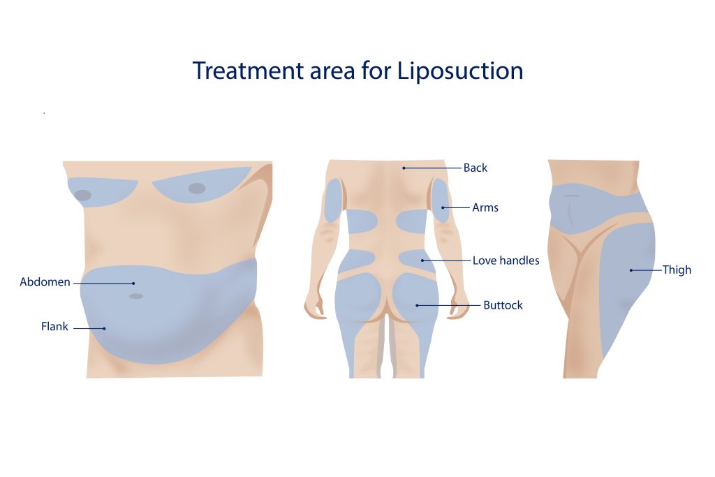Treatment area for liposuction.