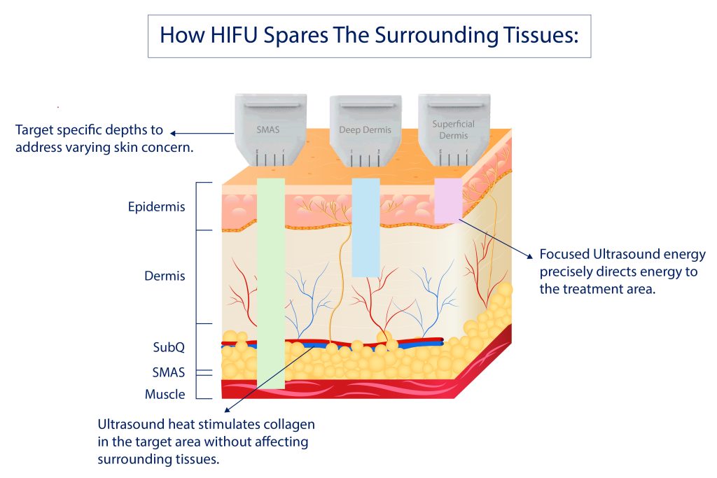 How HIFU spares the surrounding tissues.