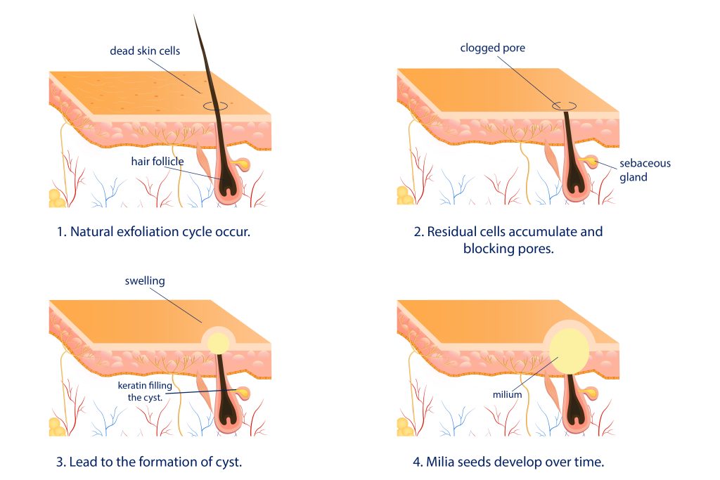 Diagram showing causes of milia seeds on skin