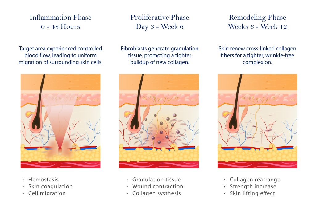 Phases of HIFU treatment.