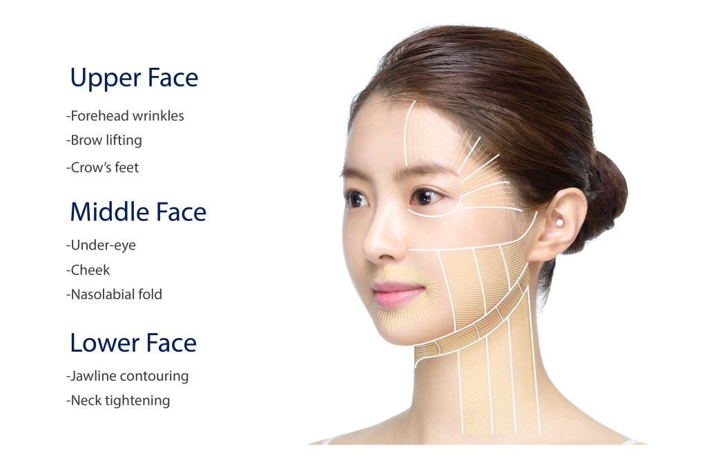 HIFU treatment will gradually tighten and lift the upper, middle, and lower face.