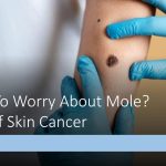 When to worry about mole? Signs of skin cancer