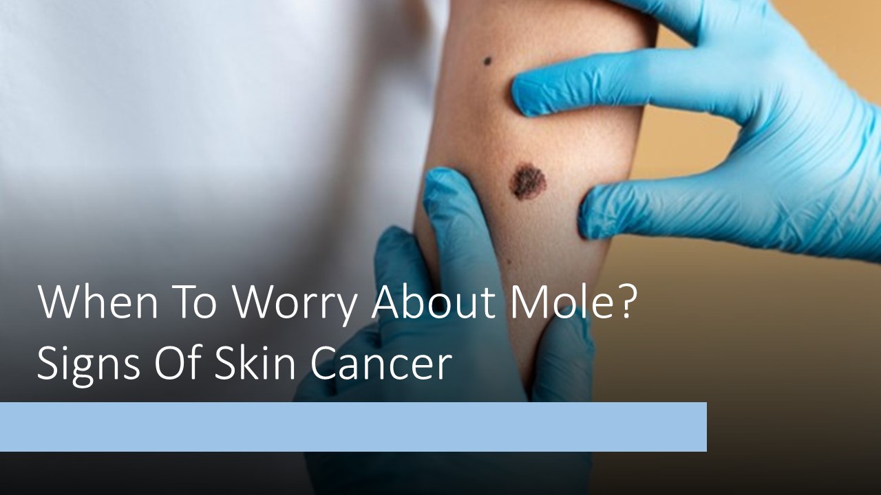 When to worry about mole? Signs of skin cancer