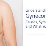 Illustration of Gynecomastia condition of the breast tissue in men.