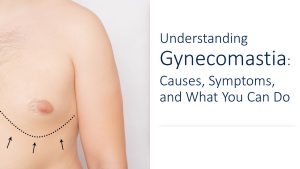 Illustration of Gynecomastia condition of the breast tissue in men.