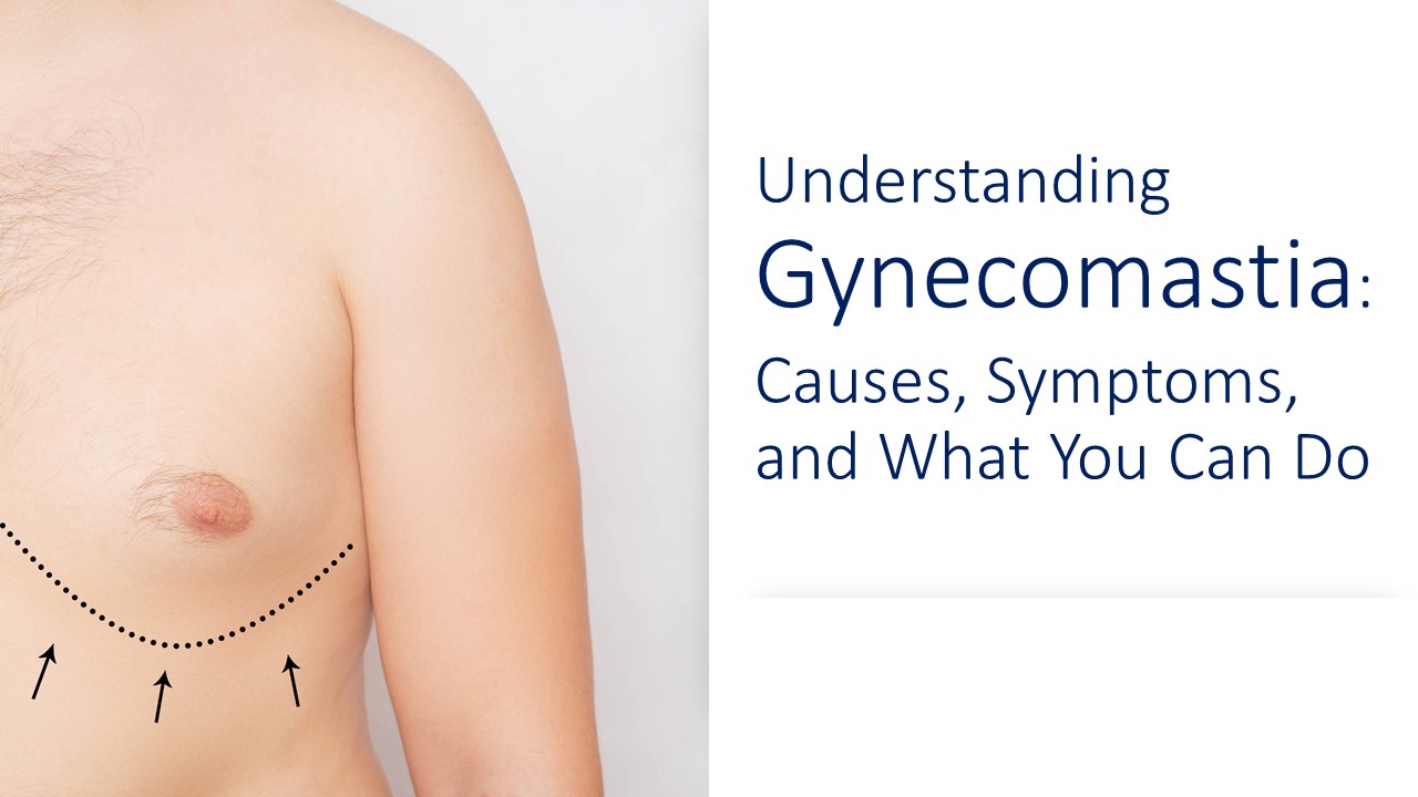 Illustration of Gynecomastia condition of the breast tissue in men.