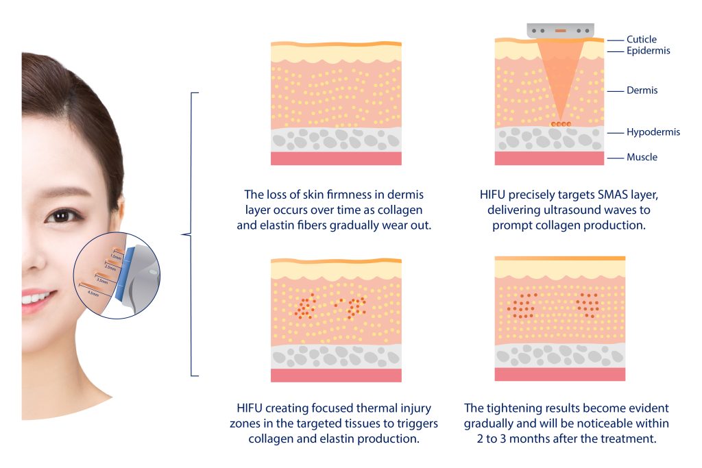 Progressive improvement with HIFU.