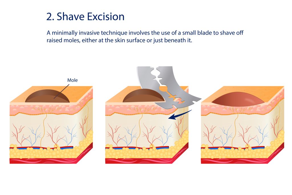 Shave Excision