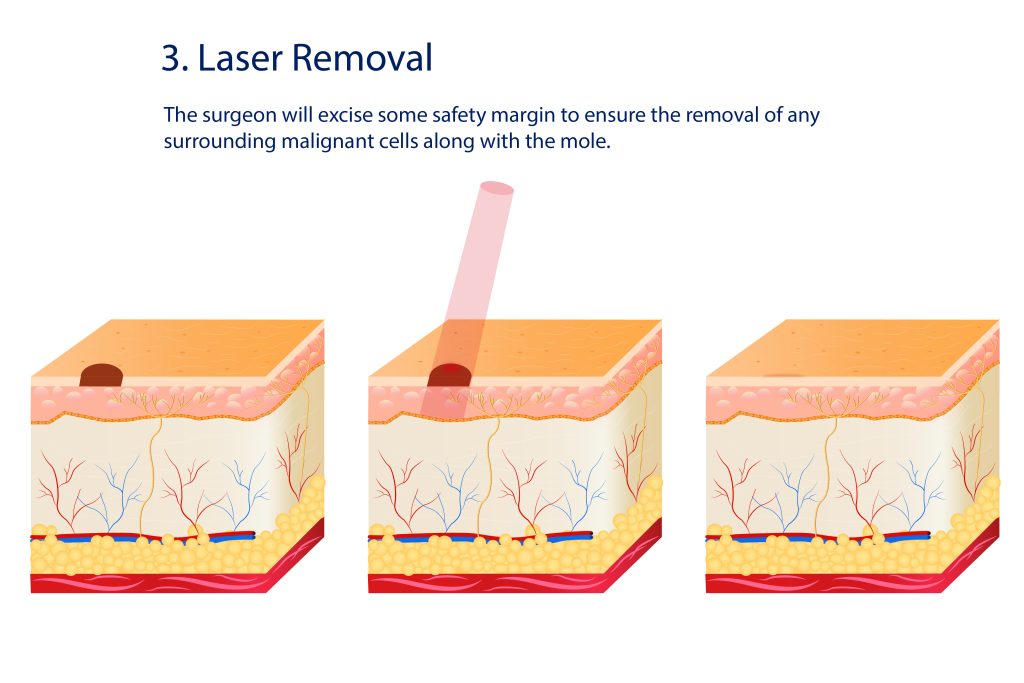 laser removal for mole